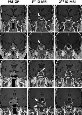 Do We Need Intraoperative Magnetic Resonance Imaging in All Endoscopic Endonasal Pituitary Adenoma Surgery Cases? A Retrospective Study